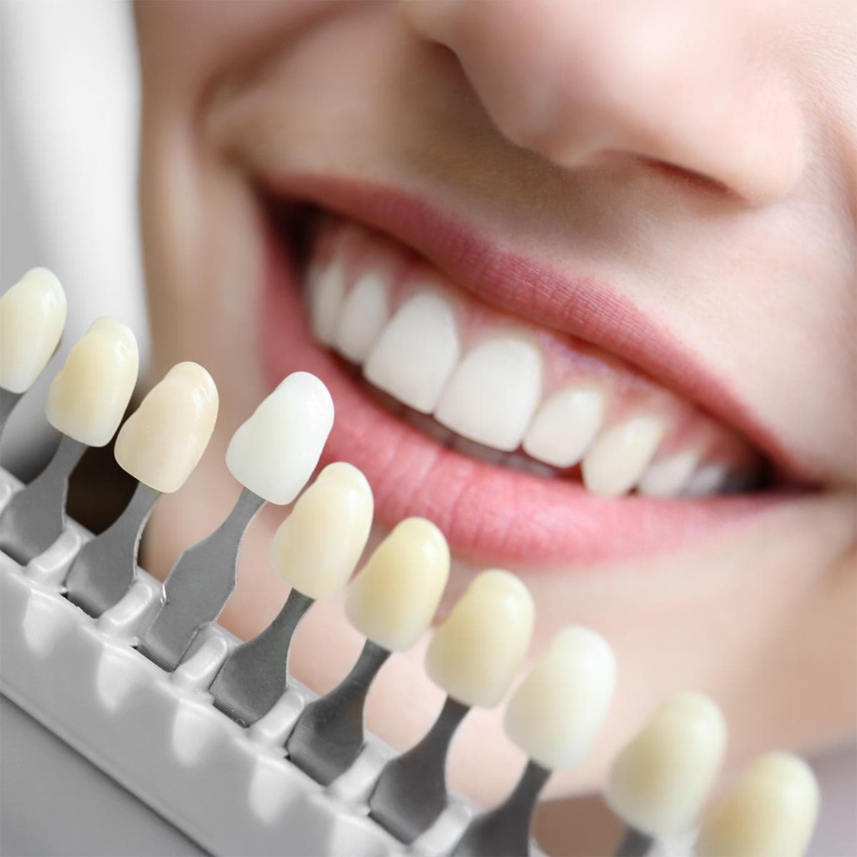 Close-up of bright smile with teeth shade guide for professional teeth whitening